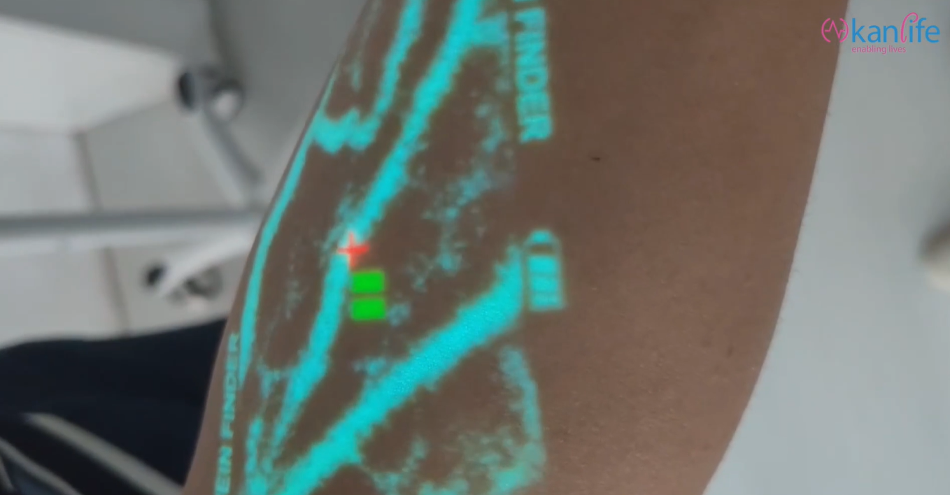Can the Kanlife Vein Finder improve the efficiency of vein puncture and reduce the number of needle sticks?